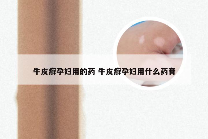 牛皮癣孕妇用的药 牛皮癣孕妇用什么药膏