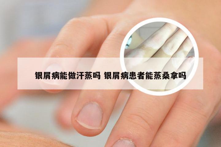 银屑病能做汗蒸吗 银屑病患者能蒸桑拿吗
