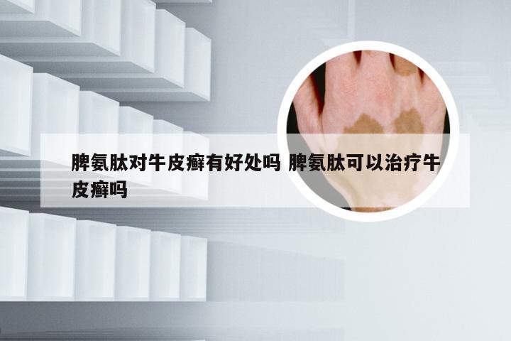 脾氨肽对牛皮癣有好处吗 脾氨肽可以治疗牛皮癣吗