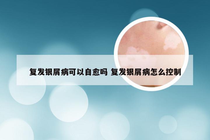 复发银屑病可以自愈吗 复发银屑病怎么控制