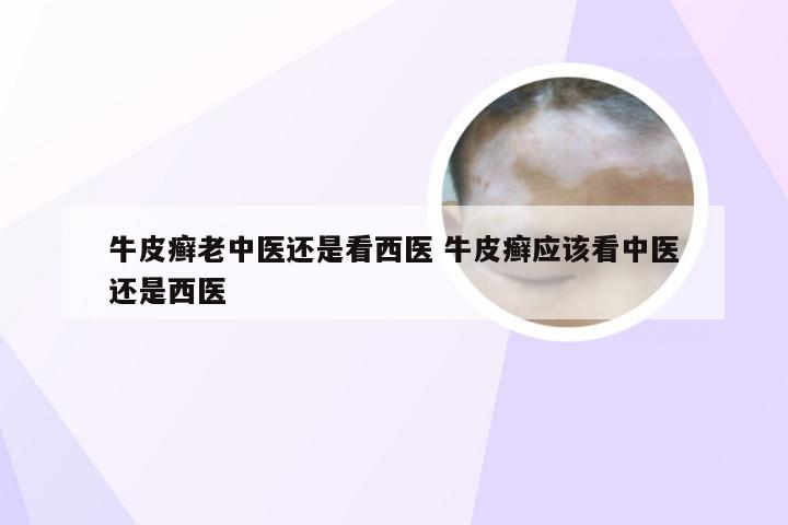 牛皮癣老中医还是看西医 牛皮癣应该看中医还是西医