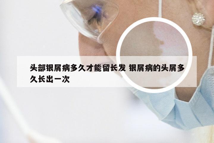 头部银屑病多久才能留长发 银屑病的头屑多久长出一次