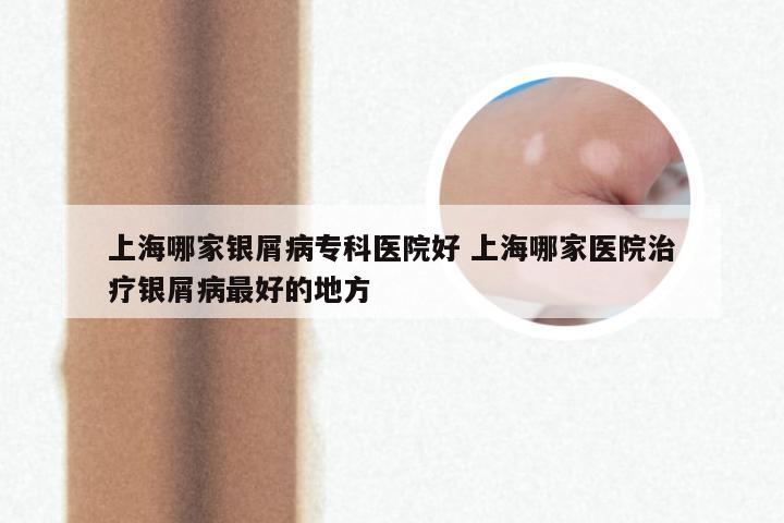 上海哪家银屑病专科医院好 上海哪家医院治疗银屑病最好的地方