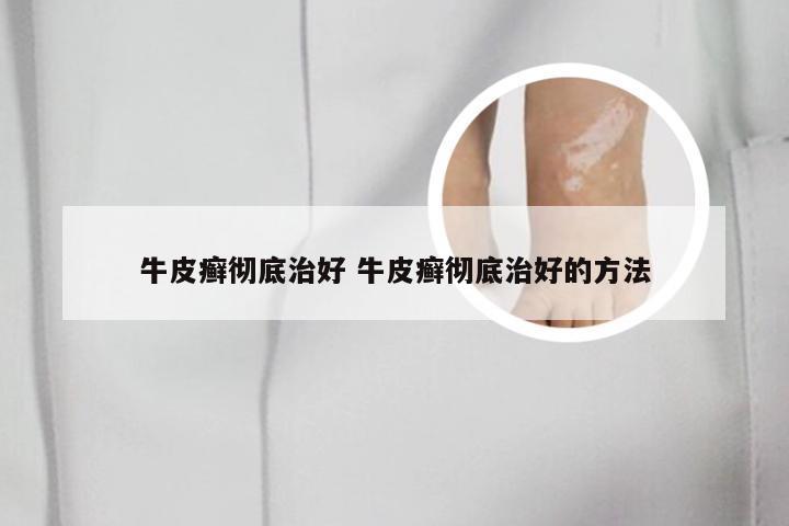 牛皮癣彻底治好 牛皮癣彻底治好的方法