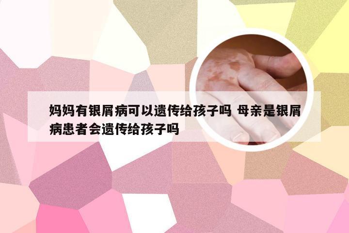 妈妈有银屑病可以遗传给孩子吗 母亲是银屑病患者会遗传给孩子吗