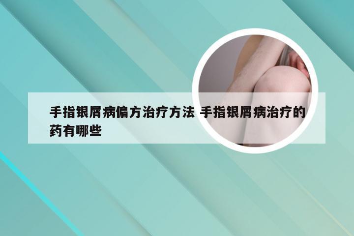 手指银屑病偏方治疗方法 手指银屑病治疗的药有哪些