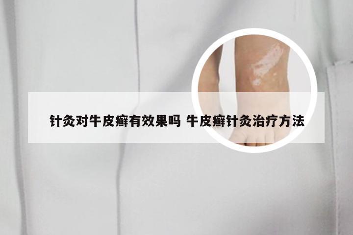 针灸对牛皮癣有效果吗 牛皮癣针灸治疗方法