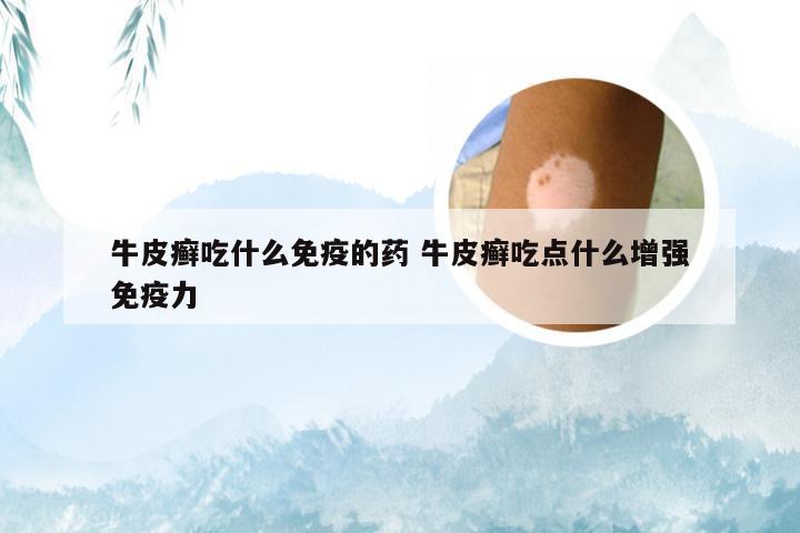 牛皮癣吃什么免疫的药 牛皮癣吃点什么增强免疫力