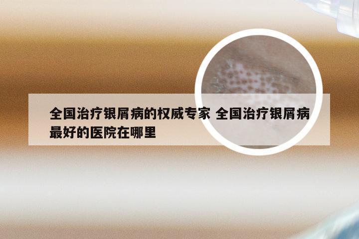 全国治疗银屑病的权威专家 全国治疗银屑病最好的医院在哪里