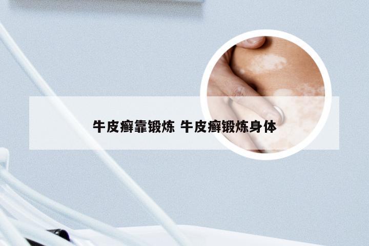 牛皮癣靠锻炼 牛皮癣锻炼身体