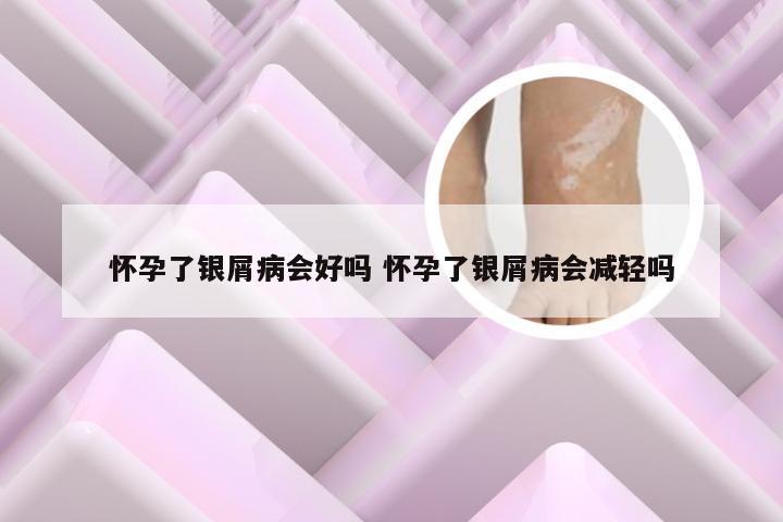 怀孕了银屑病会好吗 怀孕了银屑病会减轻吗