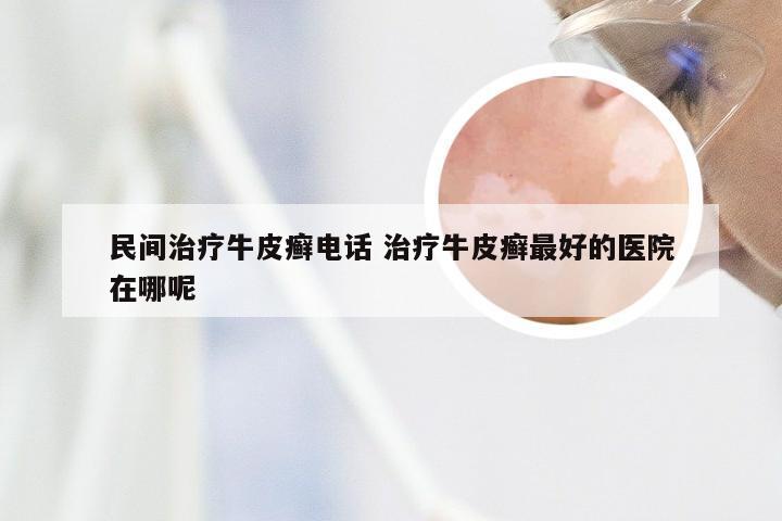 民间治疗牛皮癣电话 治疗牛皮癣最好的医院在哪呢