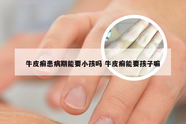 牛皮癣患病期能要小孩吗 牛皮癣能要孩子嘛