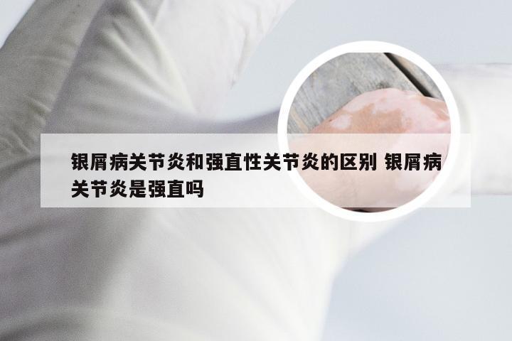 银屑病关节炎和强直性关节炎的区别 银屑病关节炎是强直吗