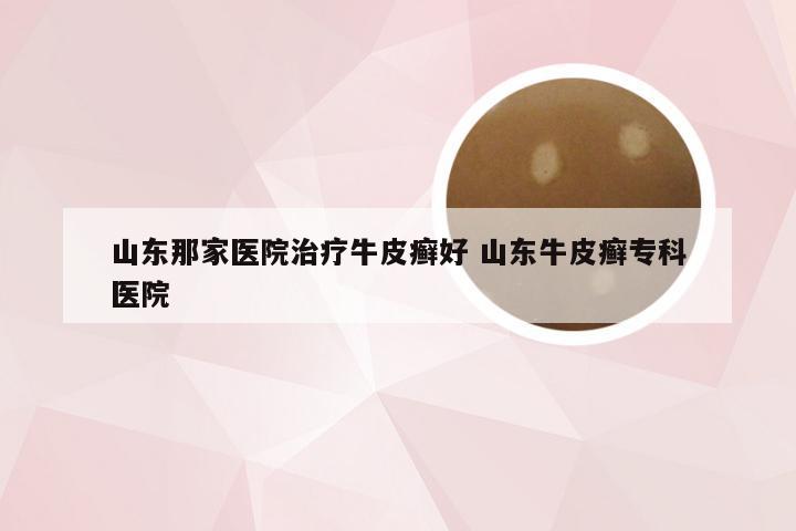 山东那家医院治疗牛皮癣好 山东牛皮癣专科医院
