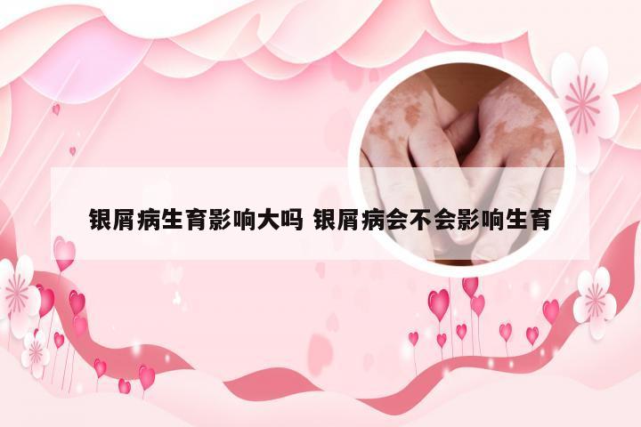 银屑病生育影响大吗 银屑病会不会影响生育