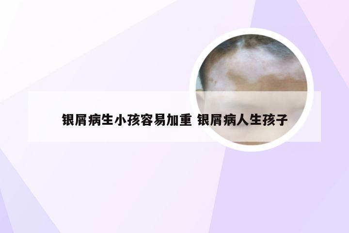 银屑病生小孩容易加重 银屑病人生孩子