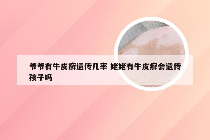爷爷有牛皮癣遗传几率 姥姥有牛皮癣会遗传孩子吗