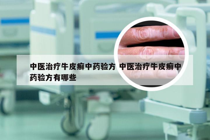中医治疗牛皮癣中药验方 中医治疗牛皮癣中药验方有哪些