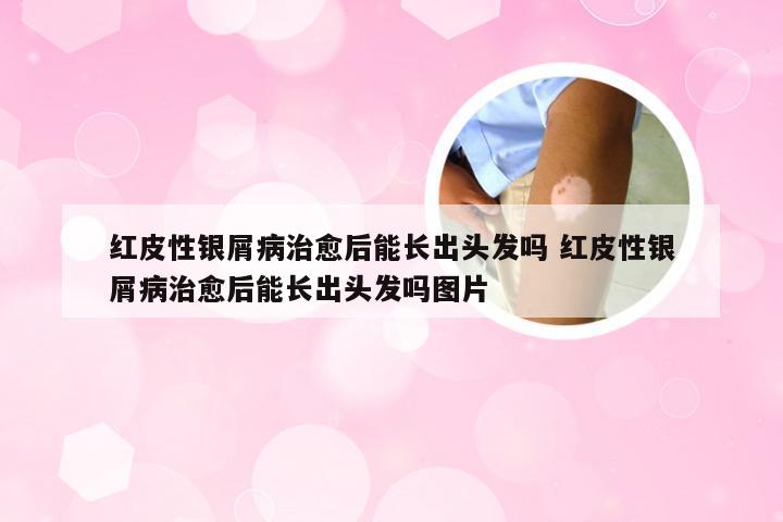 红皮性银屑病治愈后能长出头发吗 红皮性银屑病治愈后能长出头发吗图片