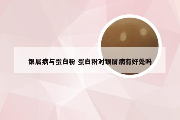 银屑病与蛋白粉 蛋白粉对银屑病有好处吗