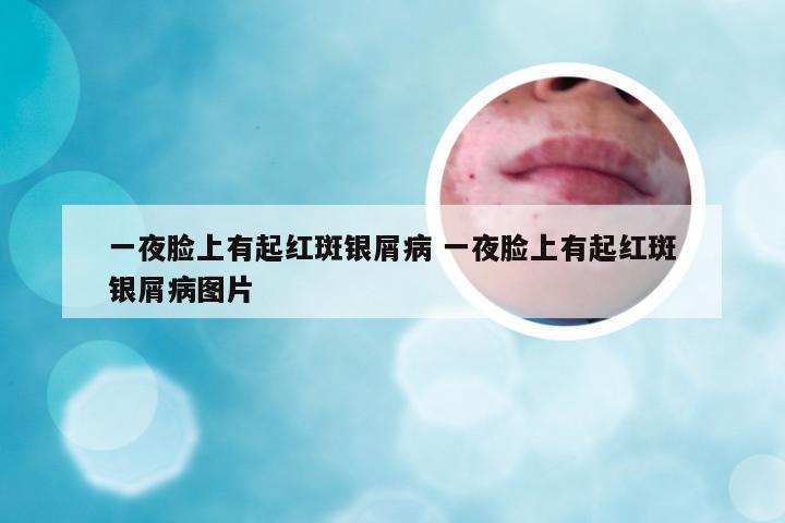 一夜脸上有起红斑银屑病 一夜脸上有起红斑银屑病图片