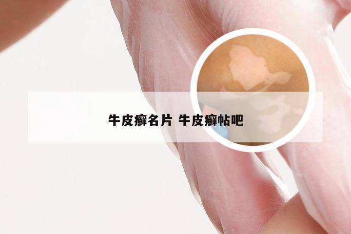 牛皮癣名片 牛皮癣帖吧