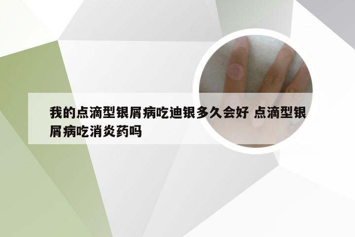 我的点滴型银屑病吃迪银多久会好 点滴型银屑病吃消炎药吗