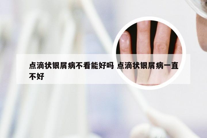 点滴状银屑病不看能好吗 点滴状银屑病一直不好