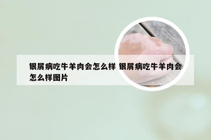 银屑病吃牛羊肉会怎么样 银屑病吃牛羊肉会怎么样图片