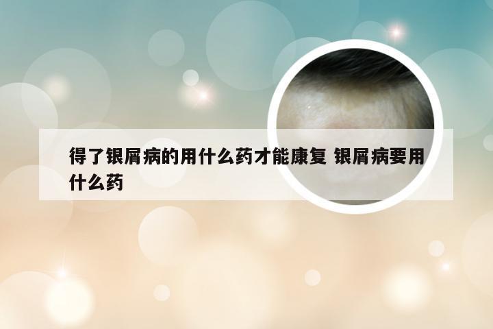 得了银屑病的用什么药才能康复 银屑病要用什么药