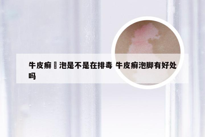 牛皮癣岀泡是不是在排毒 牛皮癣泡脚有好处吗