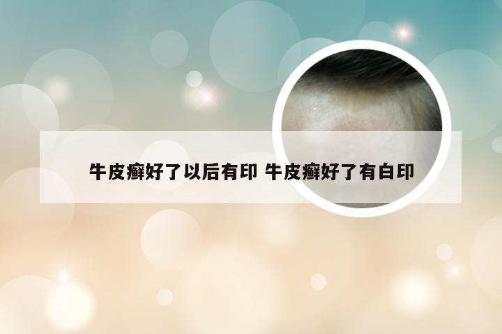 牛皮癣好了以后有印 牛皮癣好了有白印