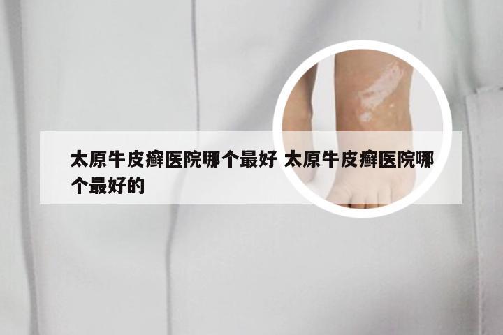 太原牛皮癣医院哪个最好 太原牛皮癣医院哪个最好的
