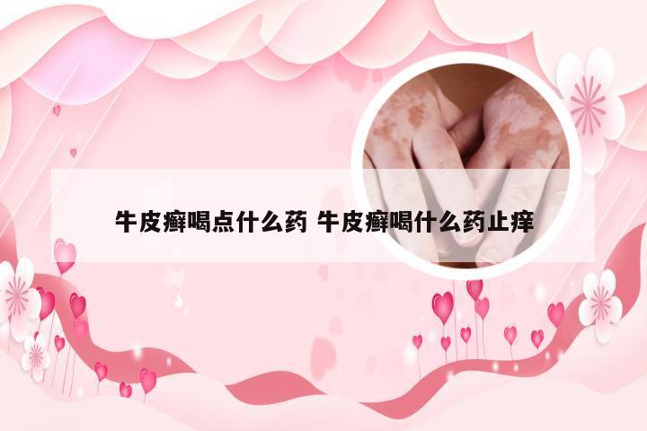 牛皮癣喝点什么药 牛皮癣喝什么药止痒