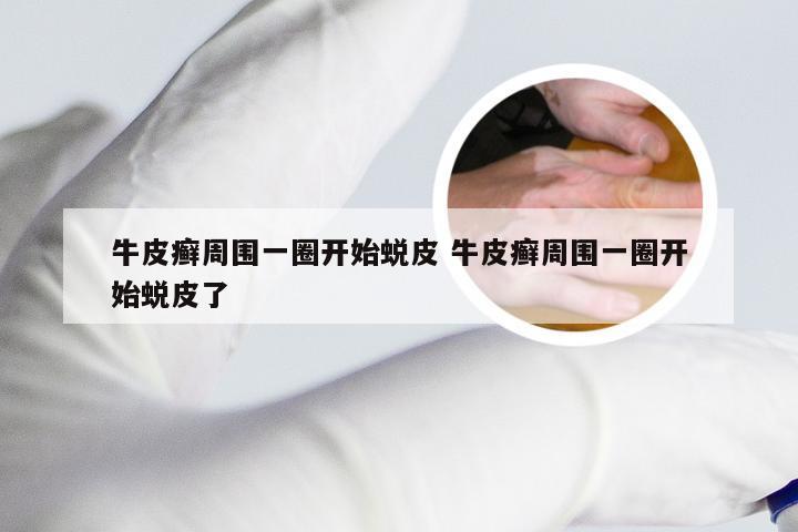 牛皮癣周围一圈开始蜕皮 牛皮癣周围一圈开始蜕皮了
