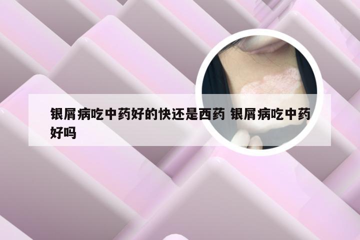 银屑病吃中药好的快还是西药 银屑病吃中药好吗