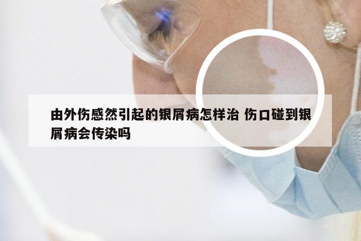 由外伤感然引起的银屑病怎样治 伤口碰到银屑病会传染吗
