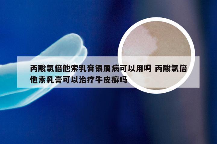 丙酸氯倍他索乳膏银屑病可以用吗 丙酸氯倍他索乳膏可以治疗牛皮癣吗