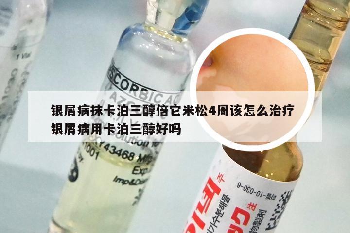 银屑病抹卡泊三醇倍它米松4周该怎么治疗 银屑病用卡泊三醇好吗