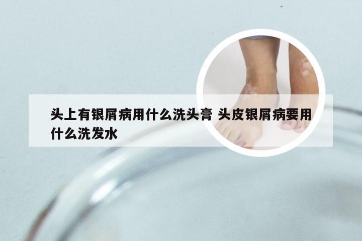 头上有银屑病用什么洗头膏 头皮银屑病要用什么洗发水