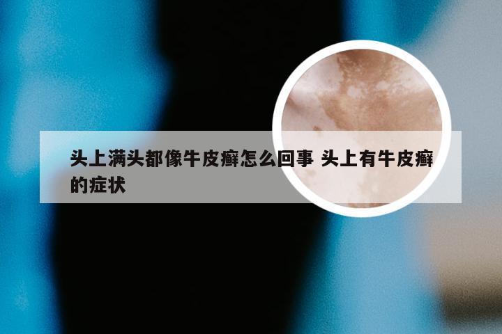 头上满头都像牛皮癣怎么回事 头上有牛皮癣的症状