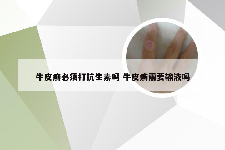牛皮癣必须打抗生素吗 牛皮癣需要输液吗