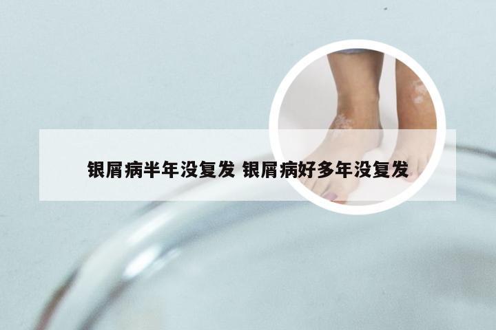 银屑病半年没复发 银屑病好多年没复发