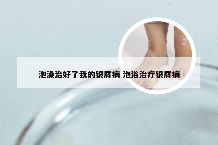 泡澡治好了我的银屑病 泡浴治疗银屑病