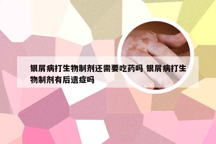 银屑病打生物制剂还需要吃药吗 银屑病打生物制剂有后遗症吗