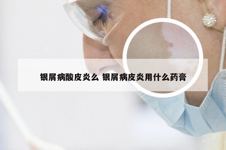 银屑病酸皮炎么 银屑病皮炎用什么药膏