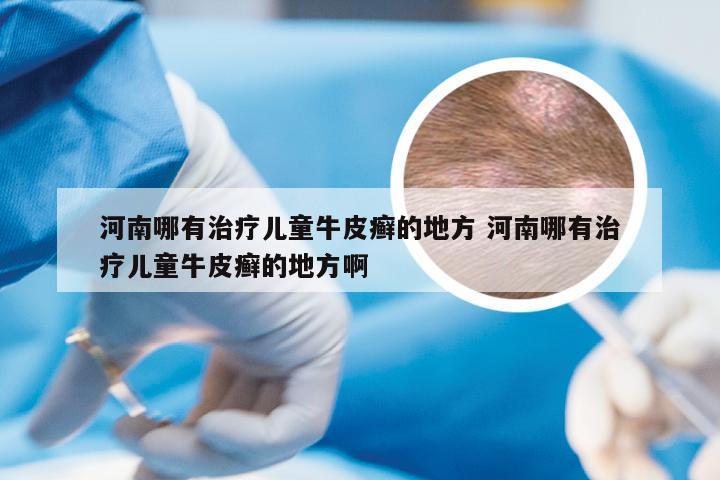 河南哪有治疗儿童牛皮癣的地方 河南哪有治疗儿童牛皮癣的地方啊