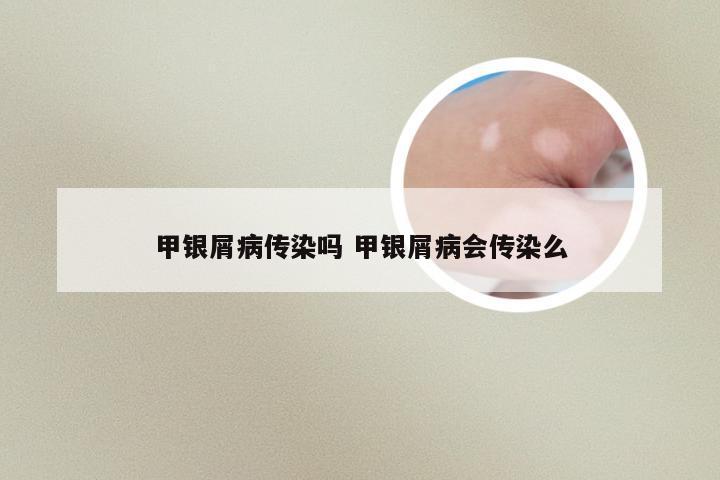 甲银屑病传染吗 甲银屑病会传染么