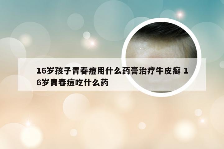 16岁孩子青春痘用什么药膏治疗牛皮癣 16岁青春痘吃什么药